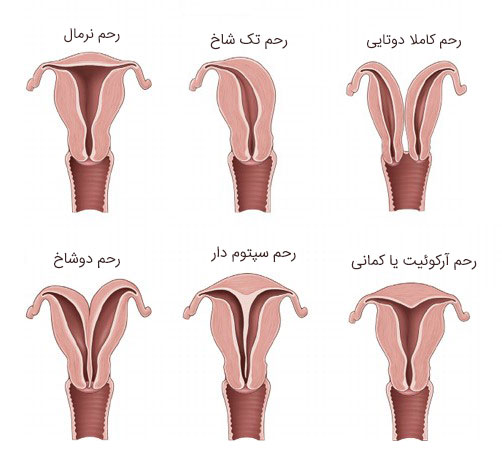 انواع ناهنجاری های رحم - رحم دوشاخ